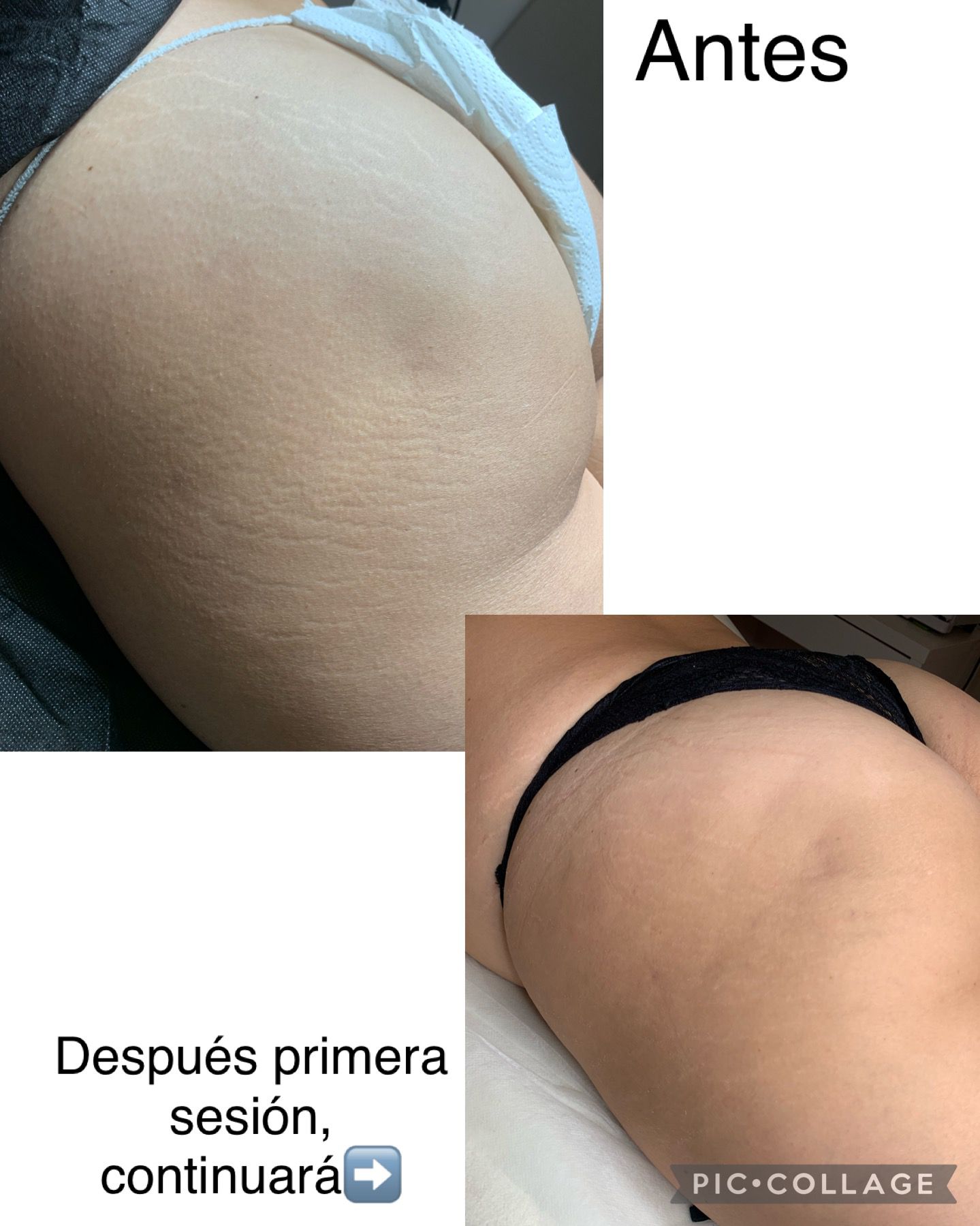 foto de la aplicación de la técnica del Dermo Ink, clínica Laurisilva