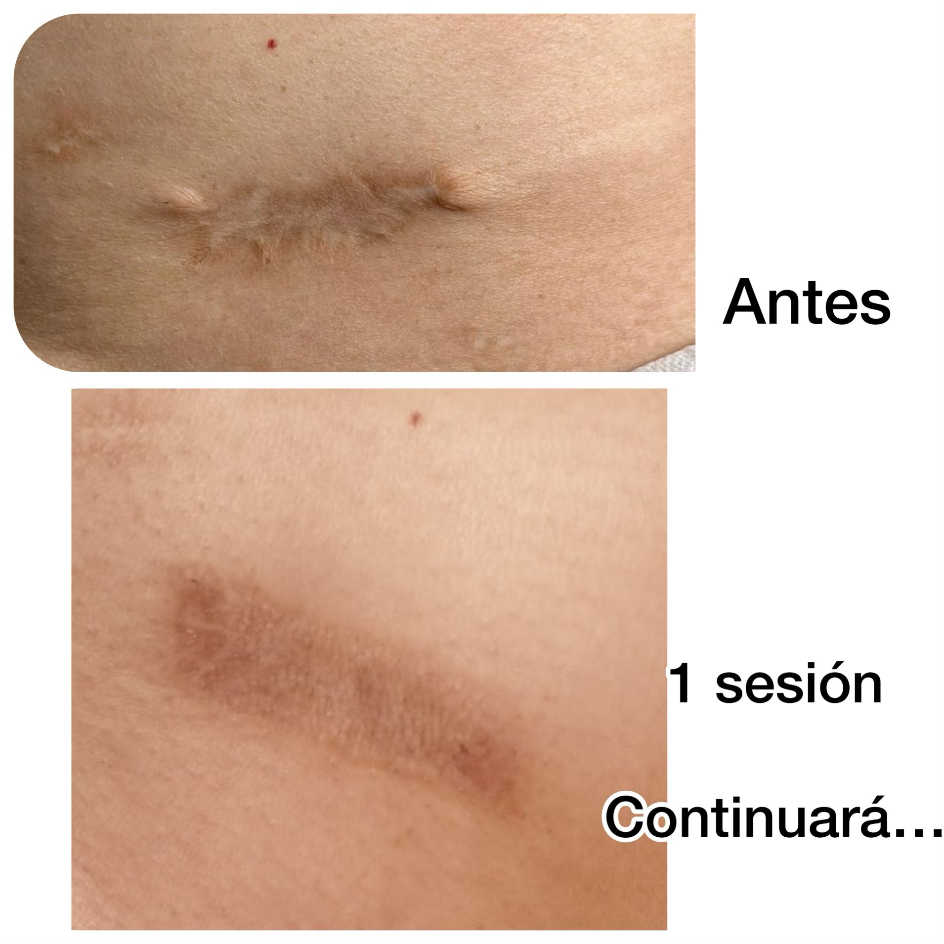 foto del cambio en el tratamiento de cicatrices, clínica Laurisilva